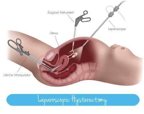 Laproscopic Hysterectomy