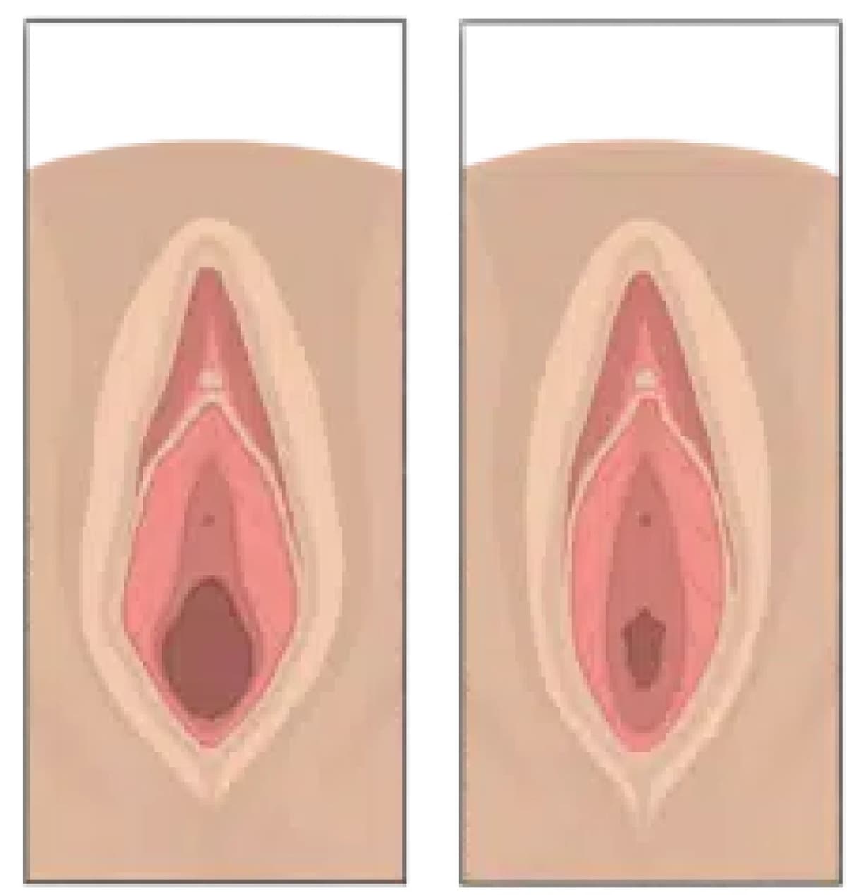 Vaginoplasty